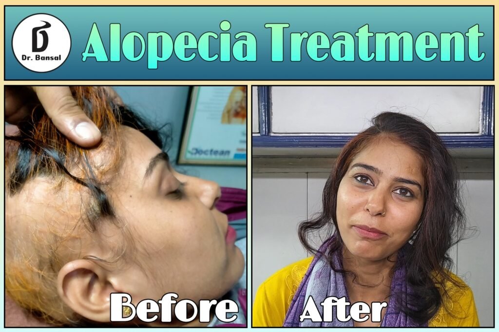 Alopecia and Hair Loss or Fall Treatment By Dr Bansal Delhi
