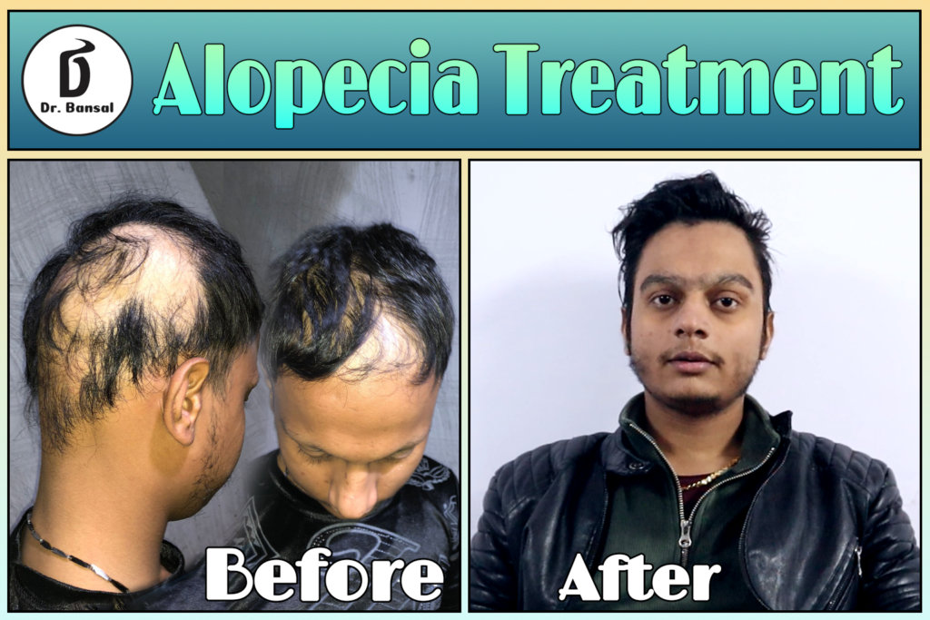 Ayurvedic Treatment For Alopecia Areata