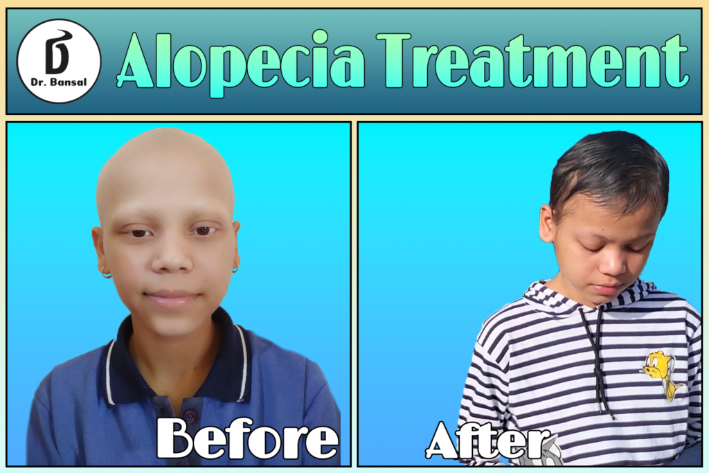 Alopecia