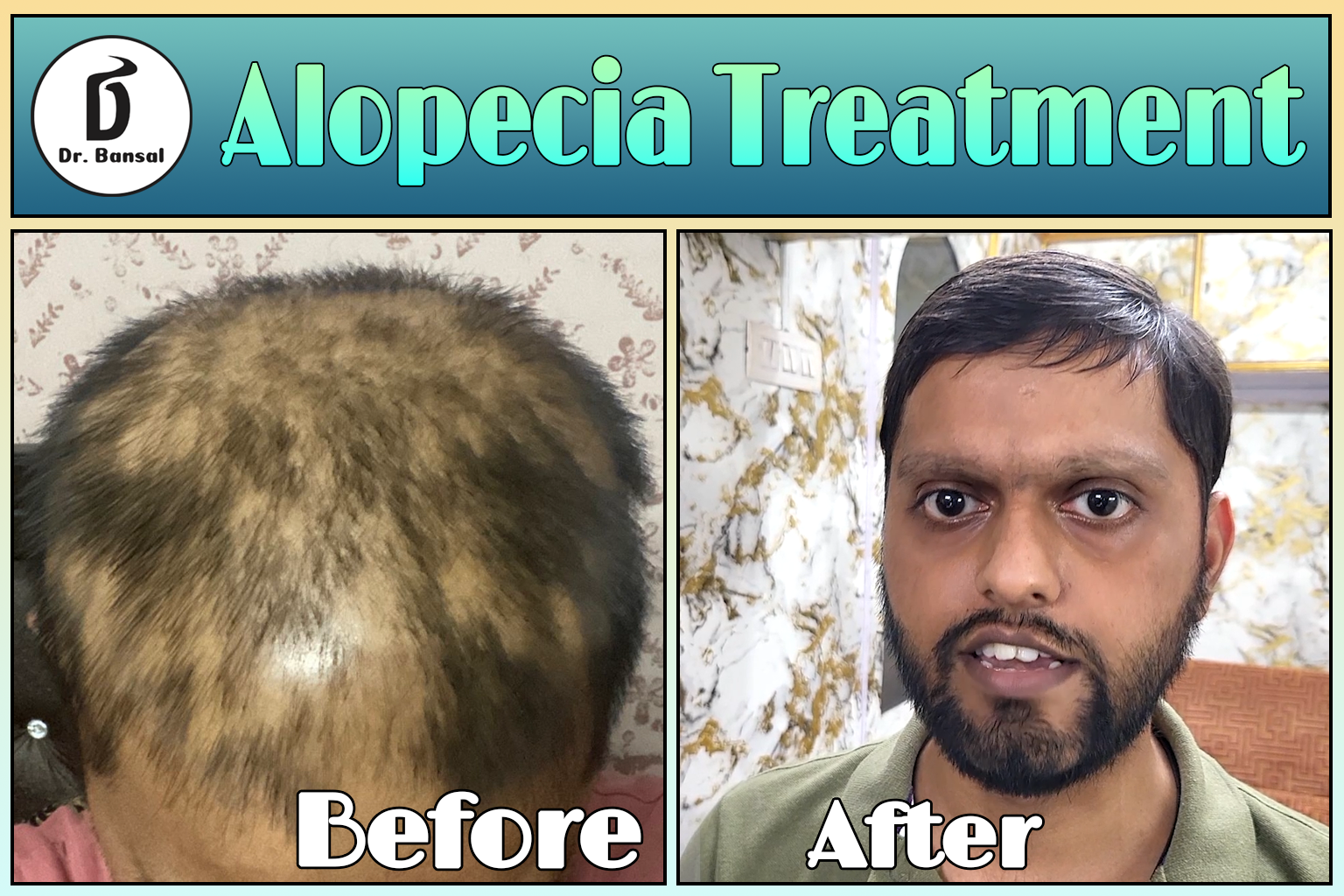 Best Hair Growth For Alopecia Areata