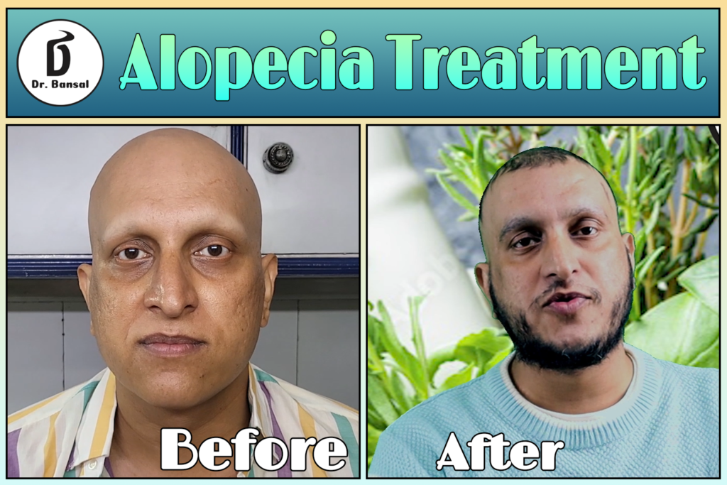 Hair Regrowth Clinic in Ghaziabad