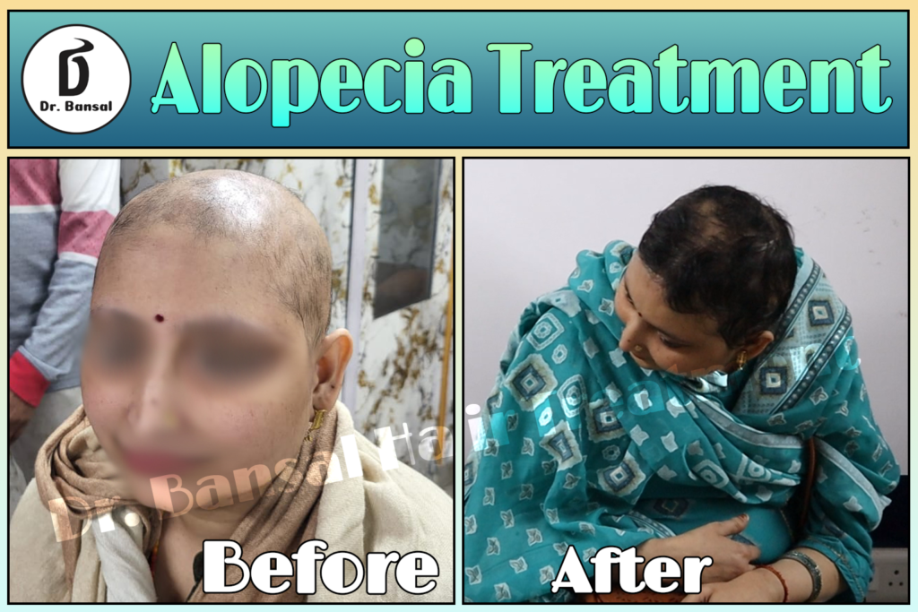 Hair Rebirth Treatment In Ghaziabad