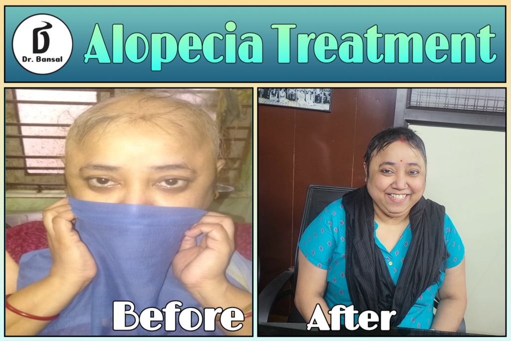 Alopecia Areata What Is It?