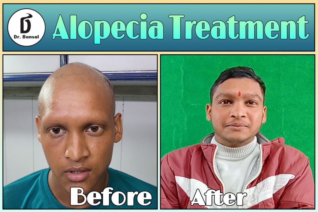 Hair Loss Treatment for Men