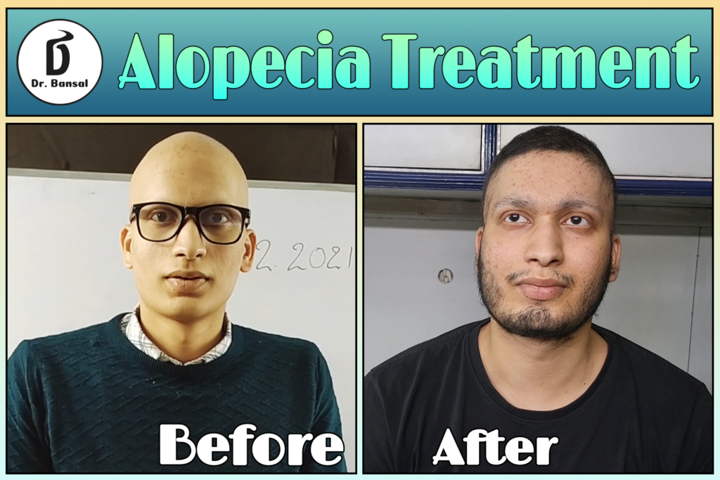 Best Alopecia Treatment In Ghaziabad