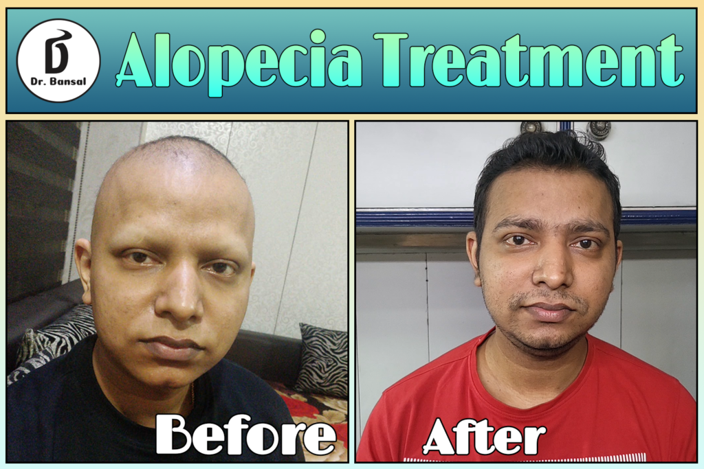 Best Hair Growth For Alopecia Areata