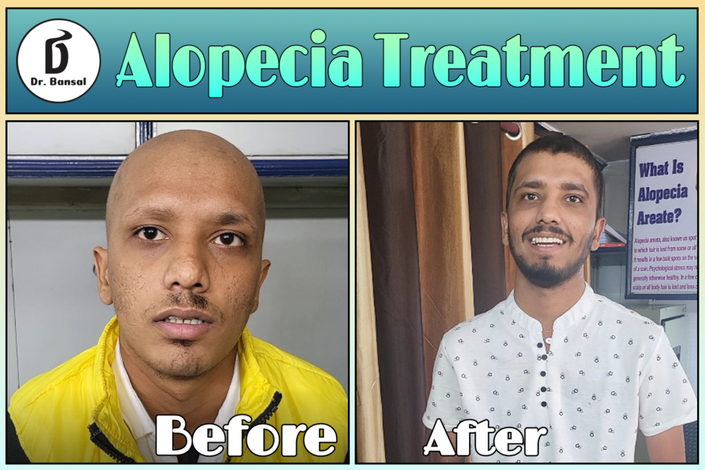 Alopecia Universalis Treatment in India