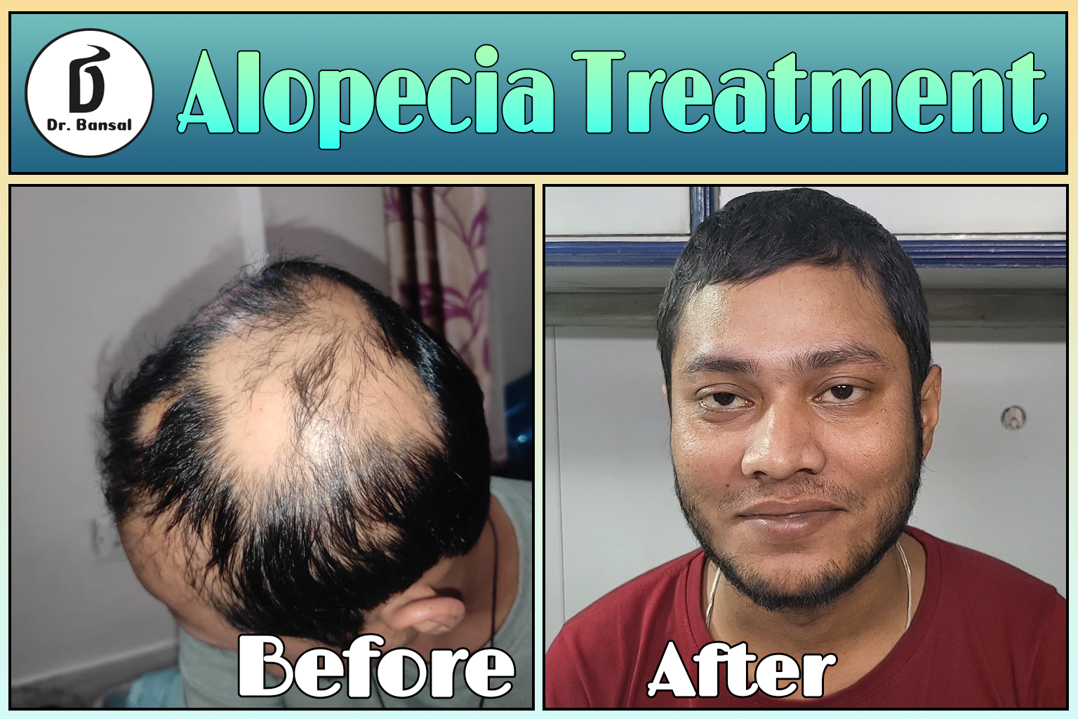 Alopecia Areata Treatment in Ghaziabad