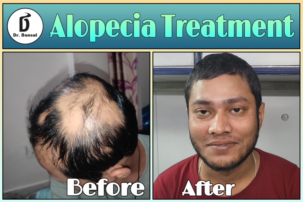 Alopecia