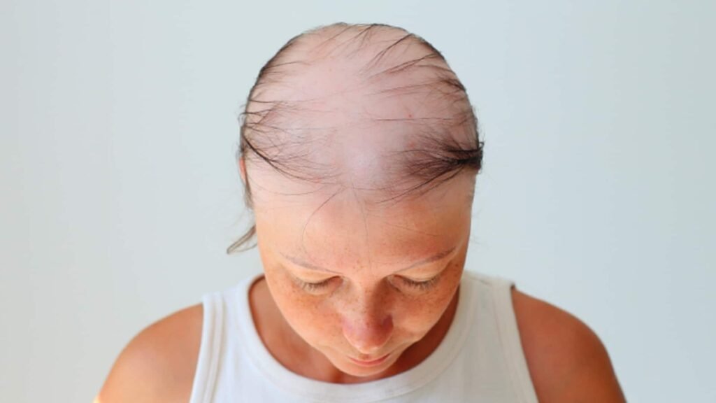 Alopecia Treatment