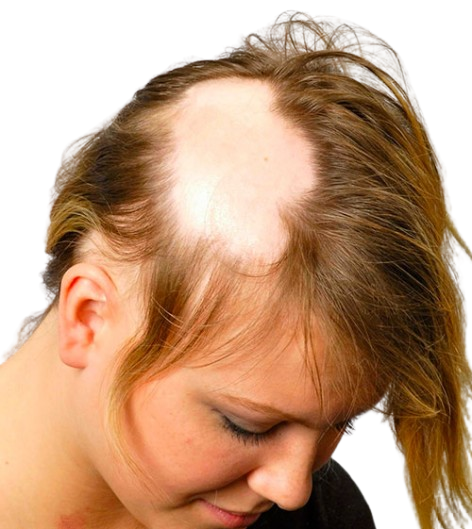 Baldness Patches On Head