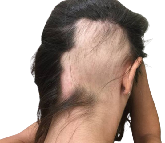 Best Alopecia Treatment In Ghaziabad