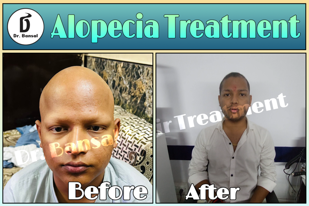 Hair Restoration