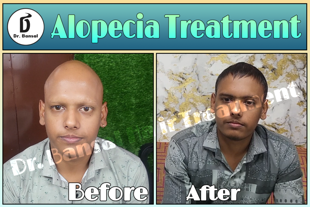 Alopecia Treatment in Uttar Pradesh