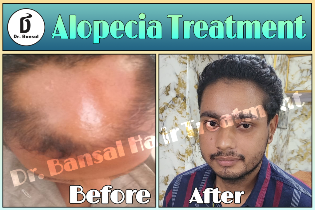 Ayurvedic Hair Loss Treatment Uttar Pradesh