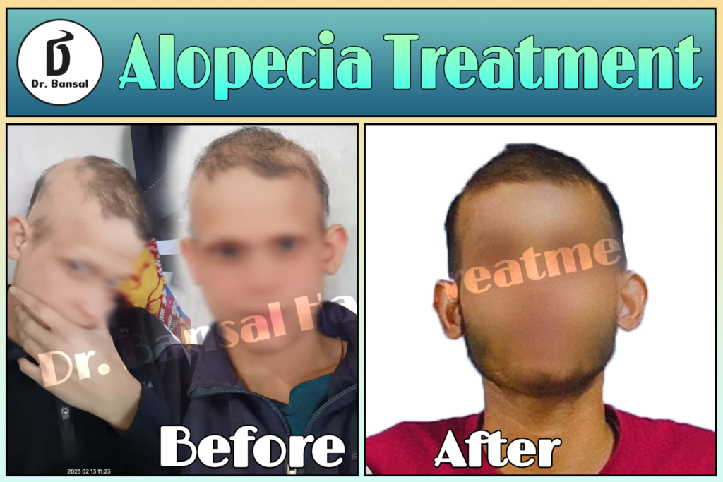 Alopecia Areata Natural Treatment