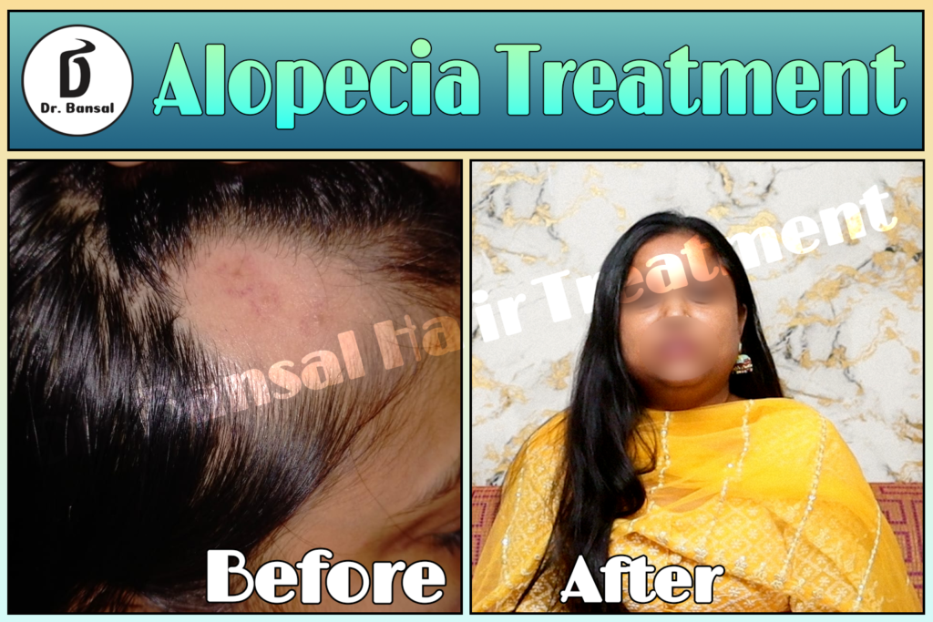 Alopecia Treatment in Uttar Pradesh