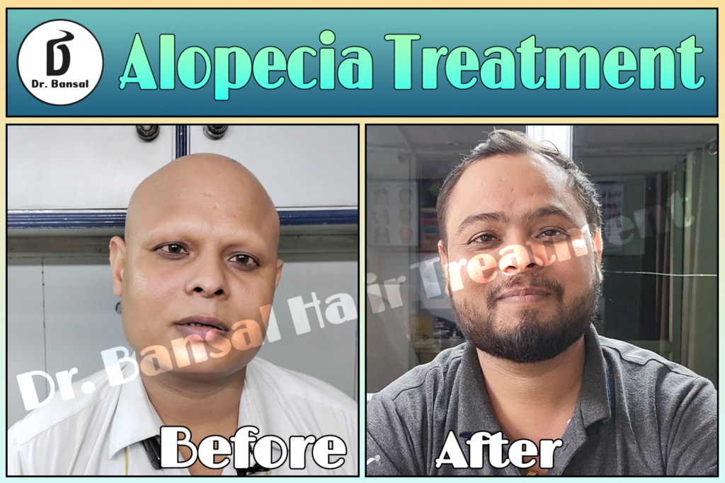 Ayurvedic Hair Loss Treatment Uttar Pradesh