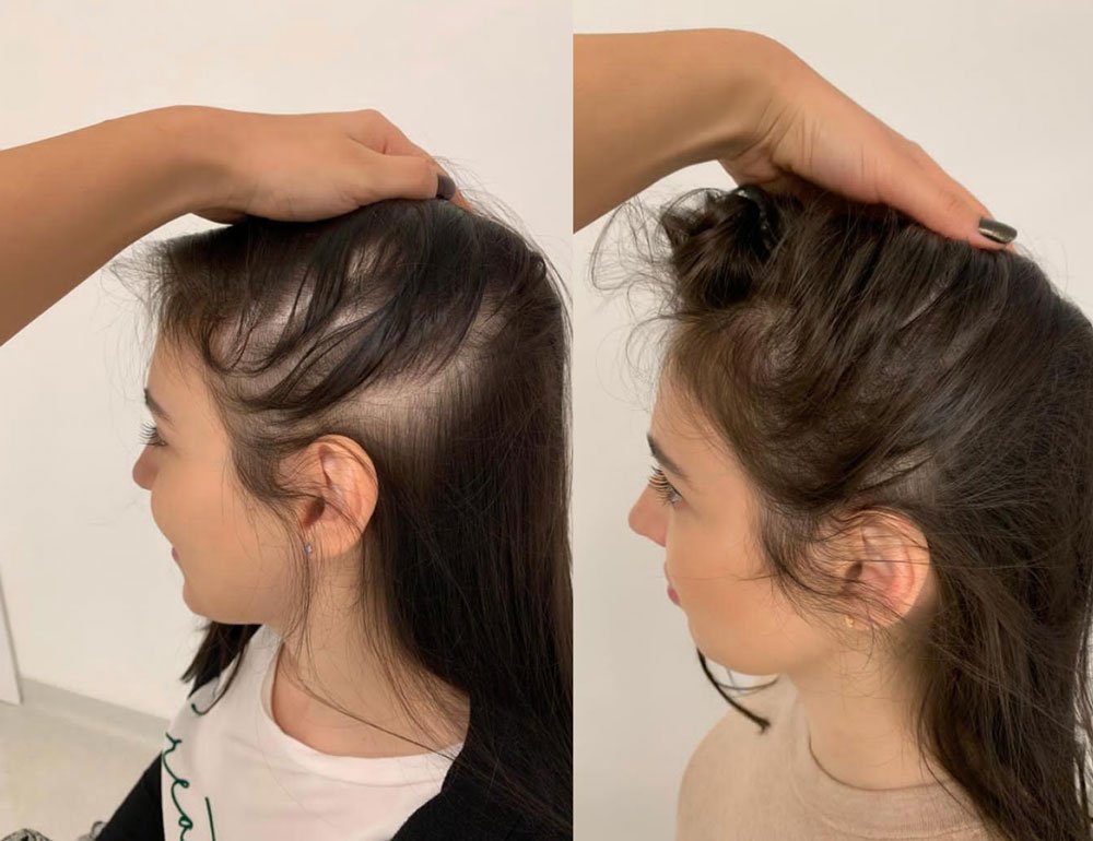 Alopecia Areata Treatment in Ghaziabad