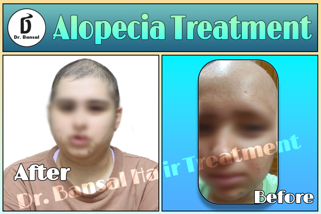 Alopecia Areata Natural Treatment