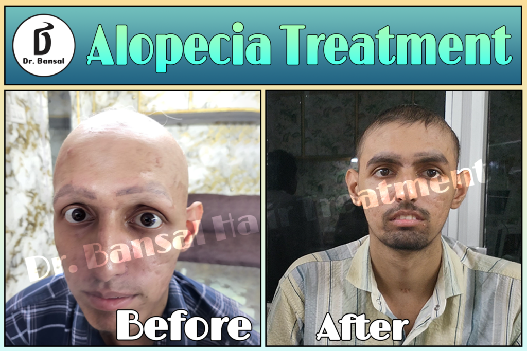 Alopecia Areata Treatment in Ghaziabad