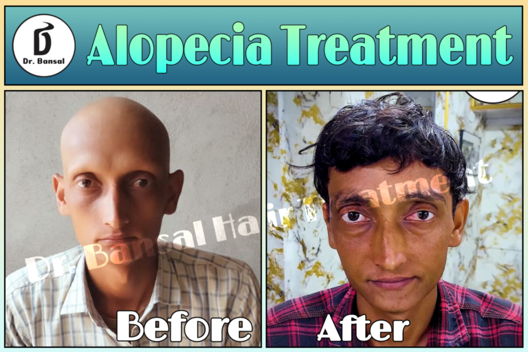 Alopecia Areata Natural Treatment