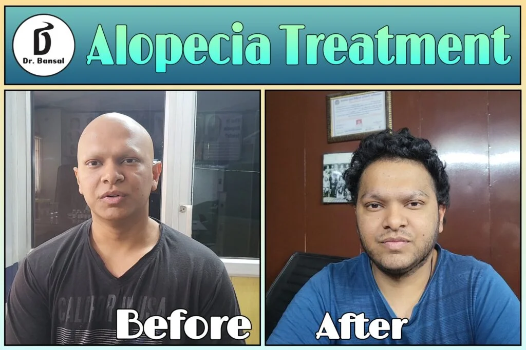 Best Medicine for Alopecia Areata