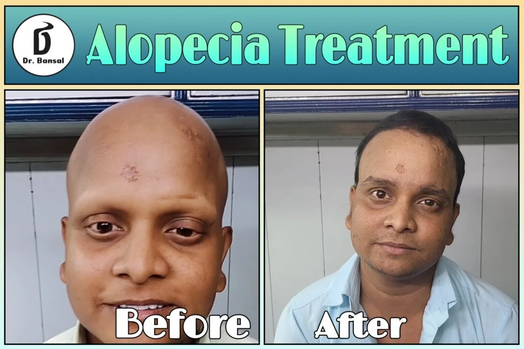 Best Medicine for Alopecia Areata