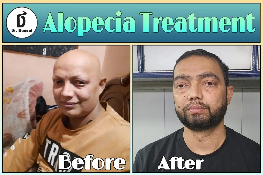 Ayurvedic Hair Growth Treatment