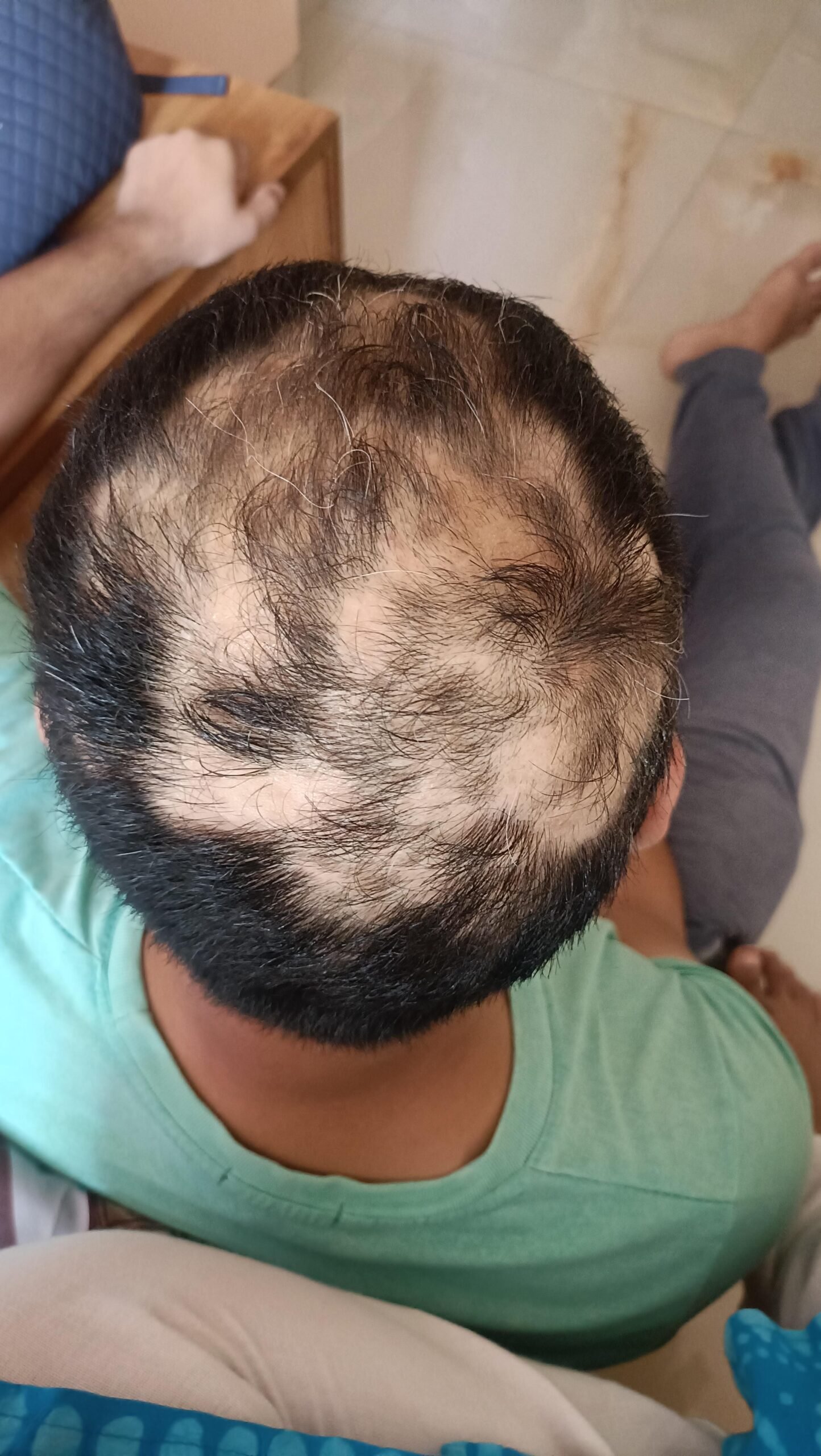 Hair Regrowth Clinic in Ghaziabad