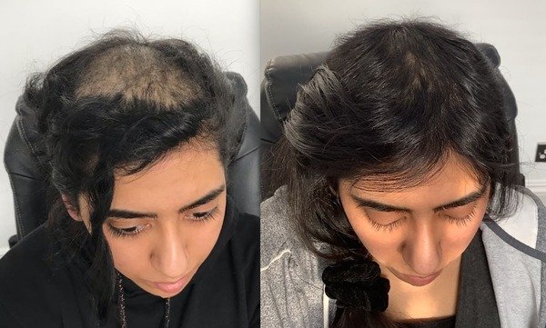 Alopecia Areata Treatment in Ghaziabad