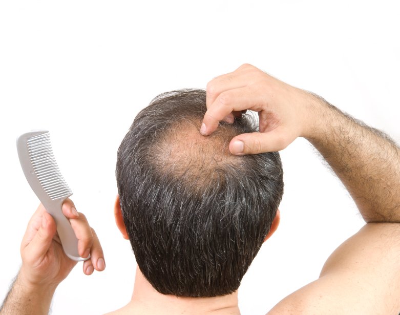 Best Medicine for Alopecia Areata