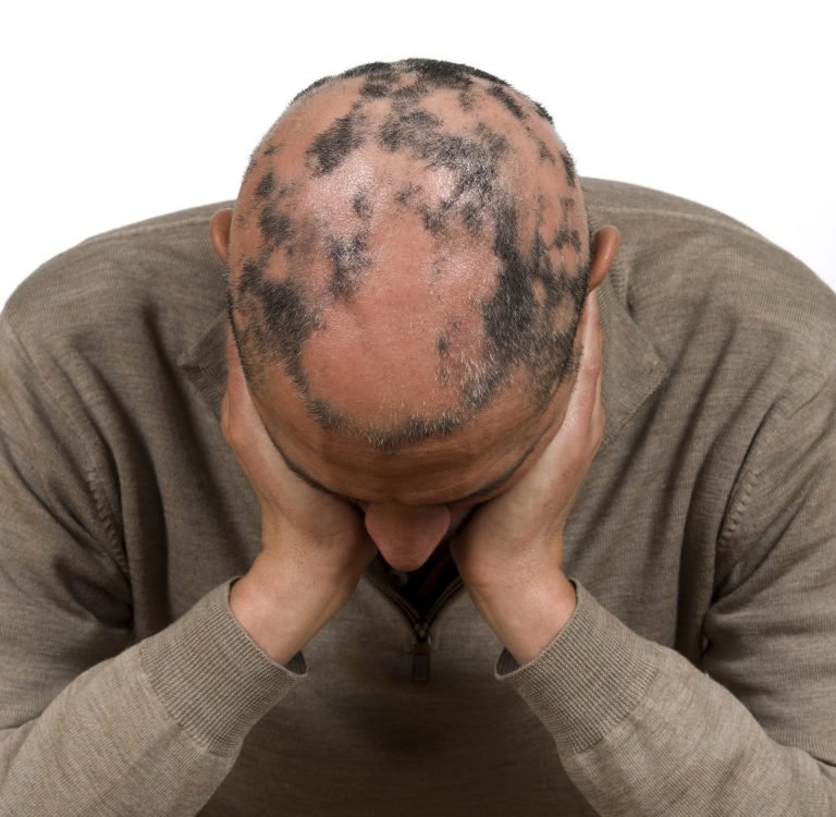 Alopecia