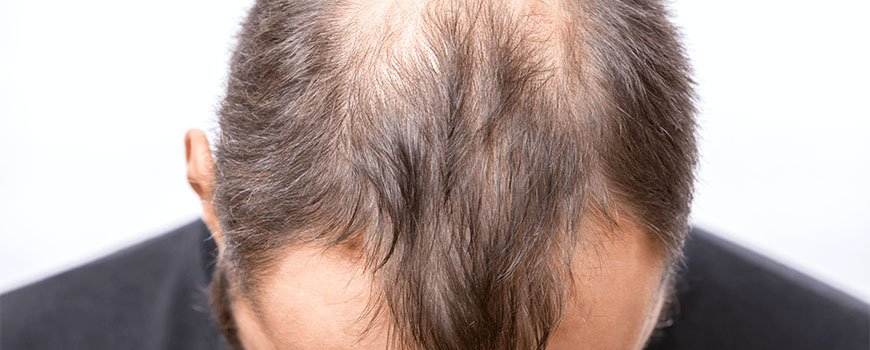 Male Hair Loss Treatment