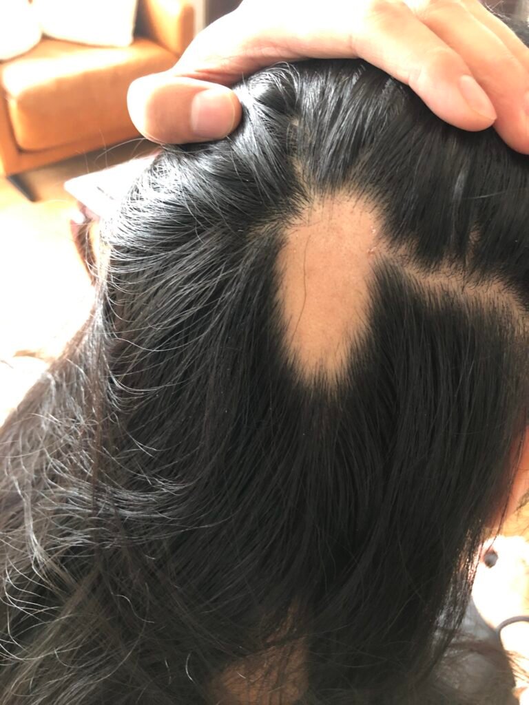 Alopecia Doctor In Ghaziabad