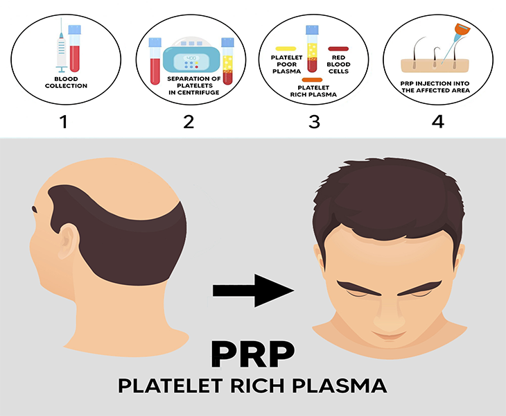 Ayurvedic PRP Treatment