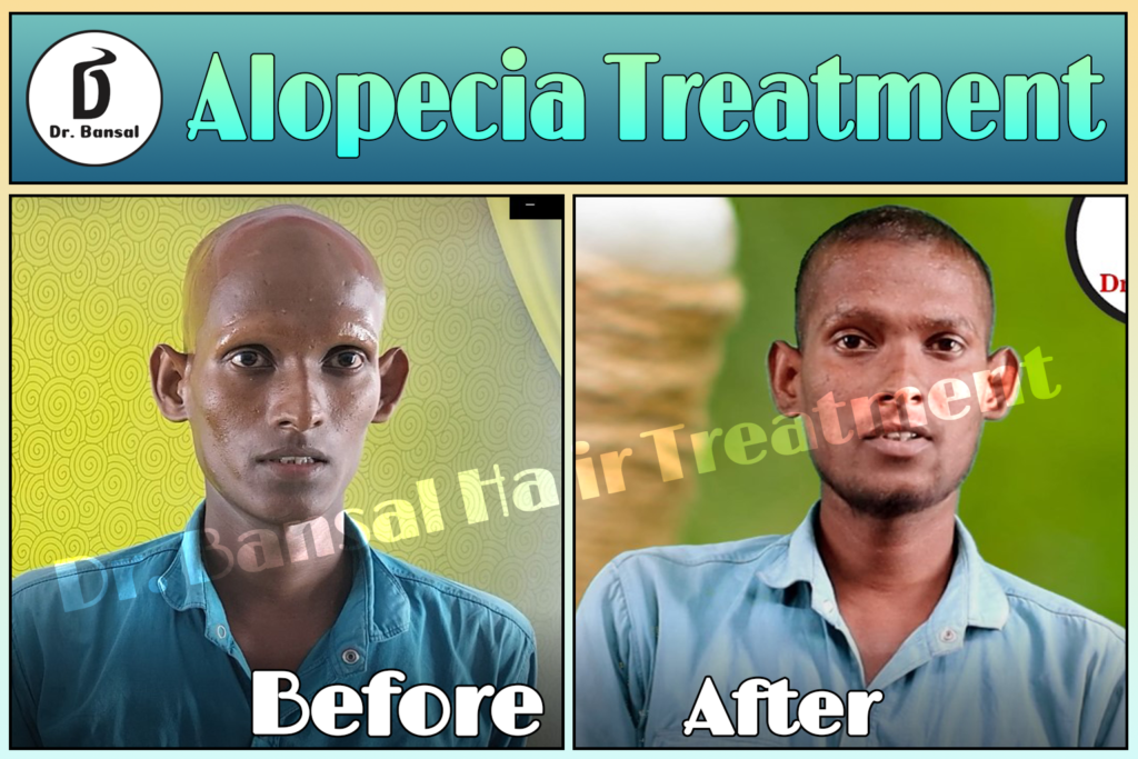 Ayurvedic Hair Loss Treatment Uttar Pradesh