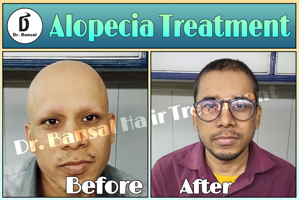 Alopecia Areata Treatment In India Benefits And Cost