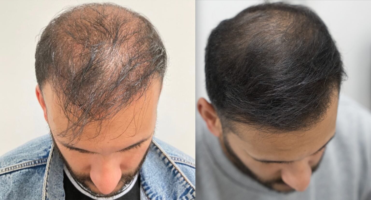 Alopecia Areata And Hair Loss