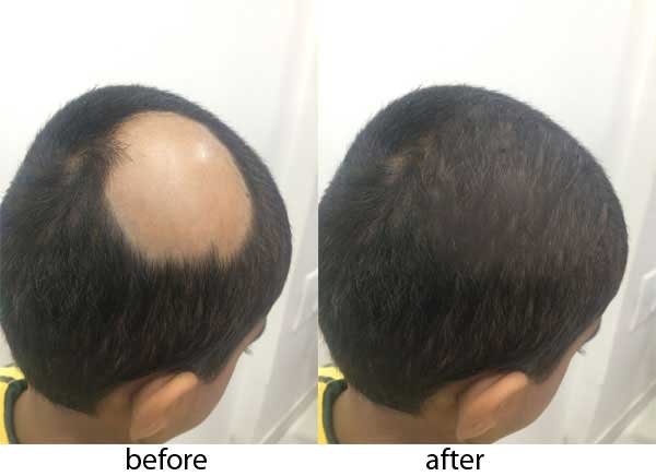 Alopecia Treatment in Uttar Pradesh