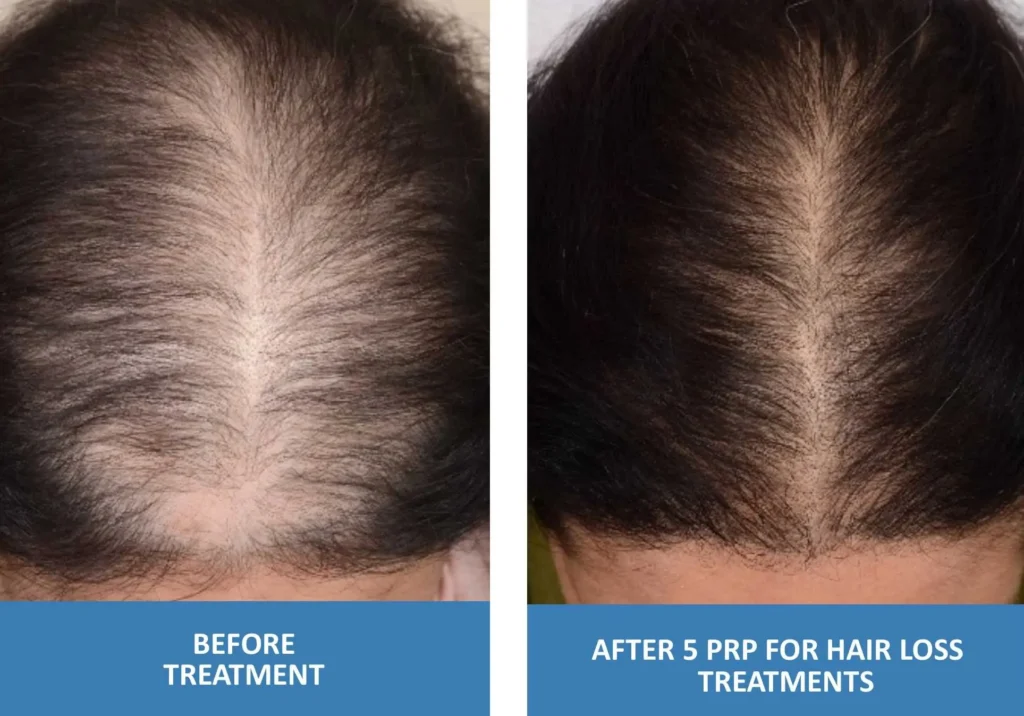 Hair Regrowth Treatments In Ghaziabad