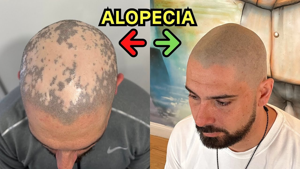 Alopecia Areata And Hair Loss