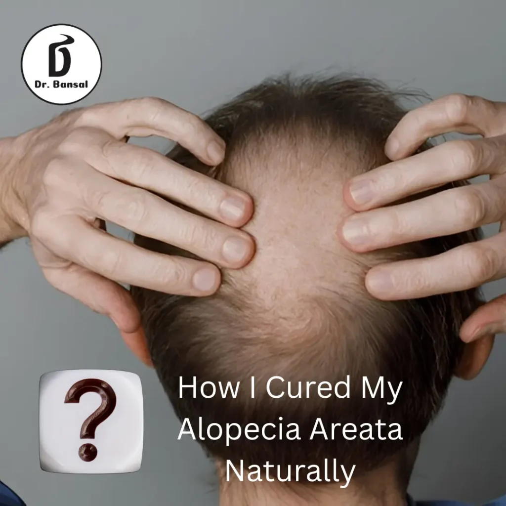 How I Cured My Alopecia Areata Naturally